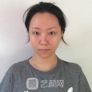 新鄉(xiāng)魏作明雙眼皮案例，