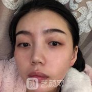 宜昌中愛李登進雙眼皮案