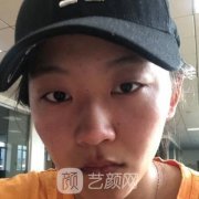 杭州賈明雙眼皮案例，真