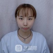 徐曉斐雙眼皮失敗修復(fù)案