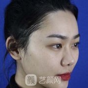 劉凱鼻子案例，手術(shù)前后