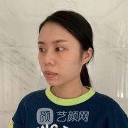 上海九院顧斌雙眼皮案例