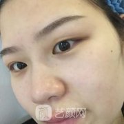 南昌韓美雙眼皮整形案例