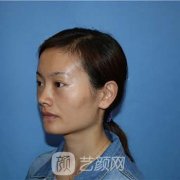 Vline+全臉面部填充整形恢