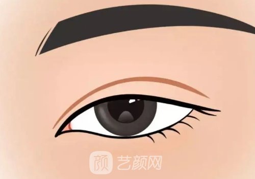 北京王偲雙眼皮費(fèi)用高嗎