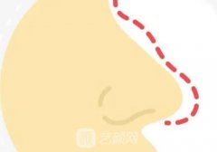 佘高明醫(yī)生做鼻子怎么樣