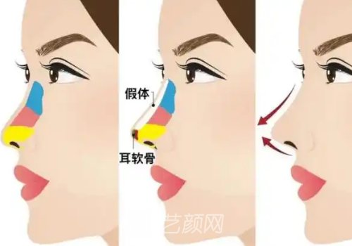 廣州紫馨整形醫(yī)院鼻子費(fèi)
