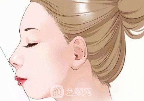 北京蕾士悅王曉健人中縮