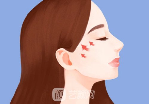 上海顴骨整形多少錢?收費(fèi)