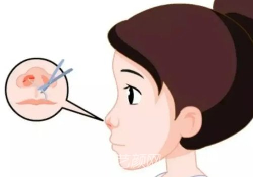 上海九院鼻子價格是多少